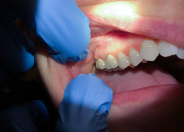 Best Emergency Wisdom Teeth Removal in Willards, MD